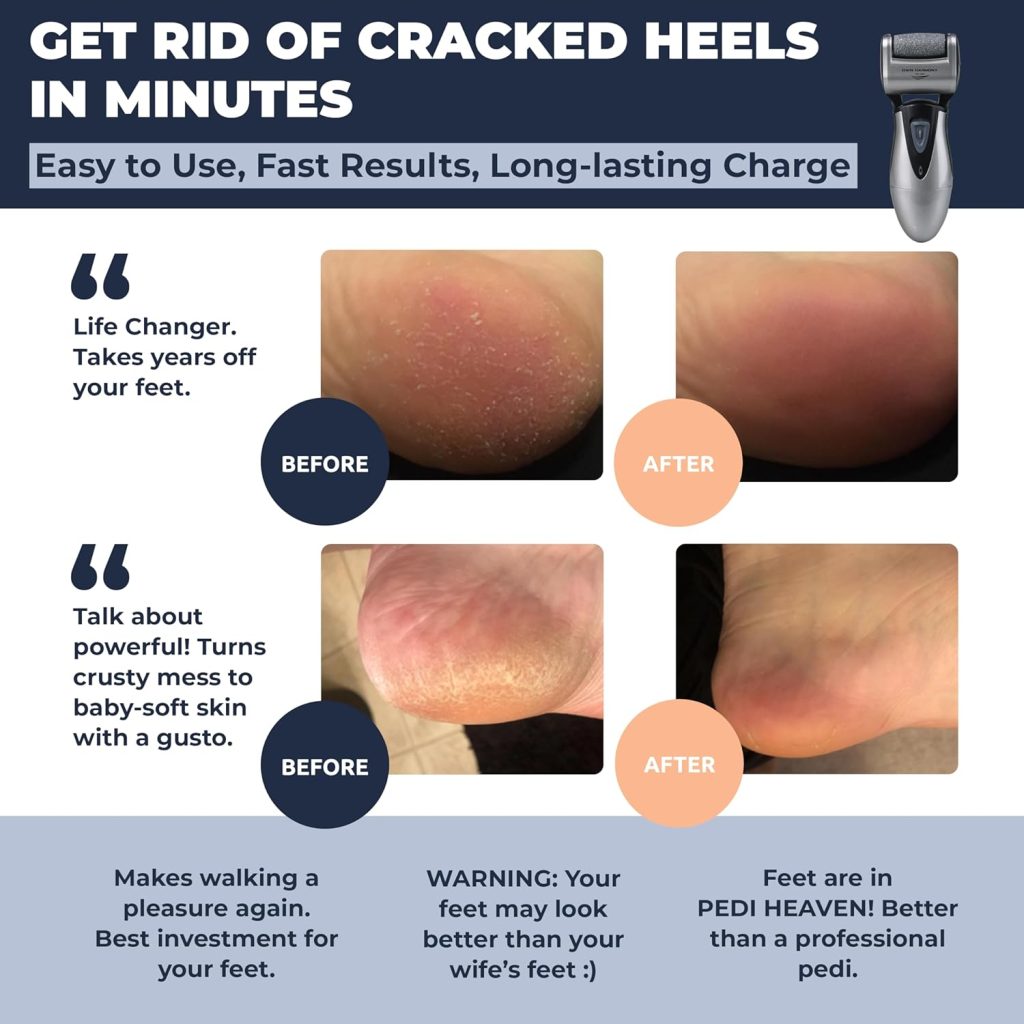 “Woman using Own Harmony CR900 electronic foot file on cracked heel to remove hard skin.”